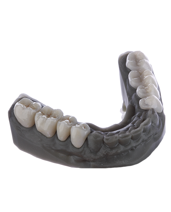 Vantagens das próteses dentárias impressas 3D