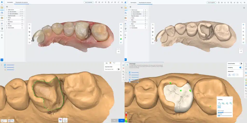 Escaneamento e planejamento digital de onlay impressa em 3D para dente posterior.