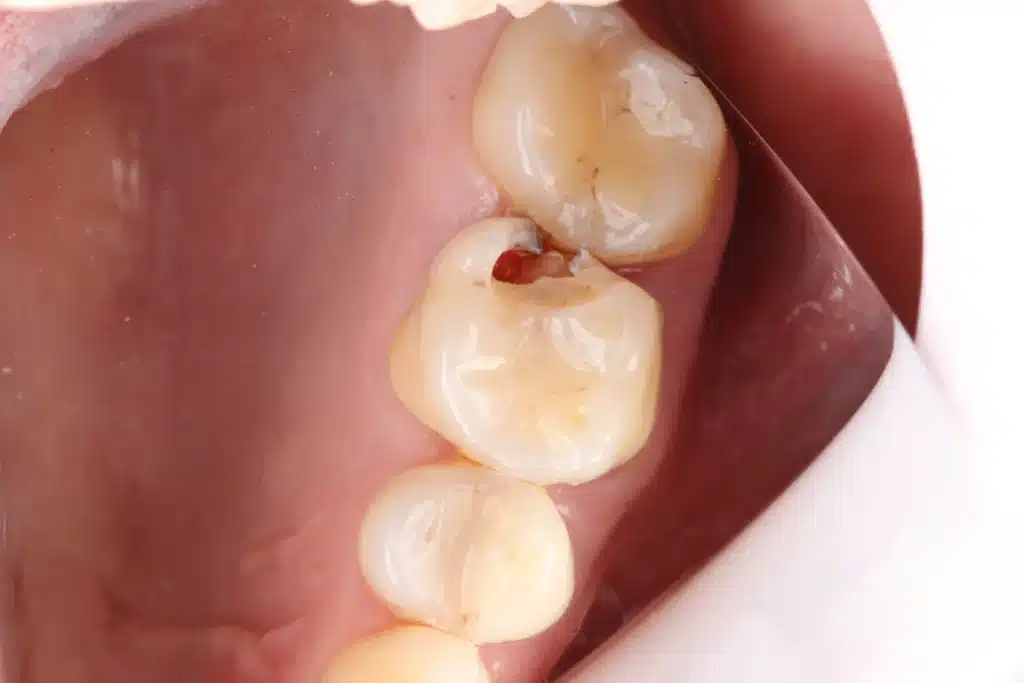 Dente 26 com cavidade classe II antes do tratamento conservador