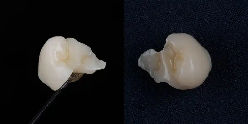 Onlay impressa em 3D com resina Bio Crown Diamond Makertech Labs.