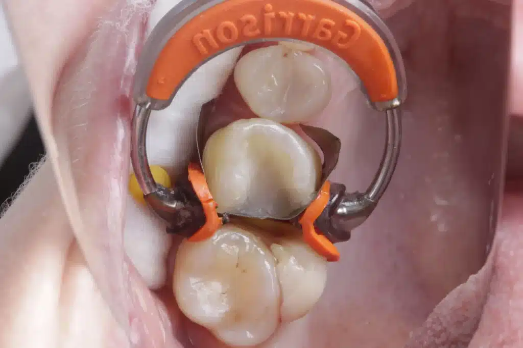Remanescente dental preparado para reconstrução antes da onlay impressa em 3D