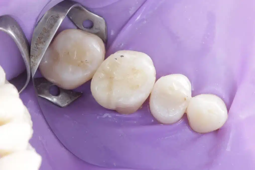 Preservação dental com abordagem conservadora completa.